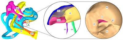 Image-Based Planning of Minimally Traumatic Inner Ear Access for Robotic Cochlear Implantation